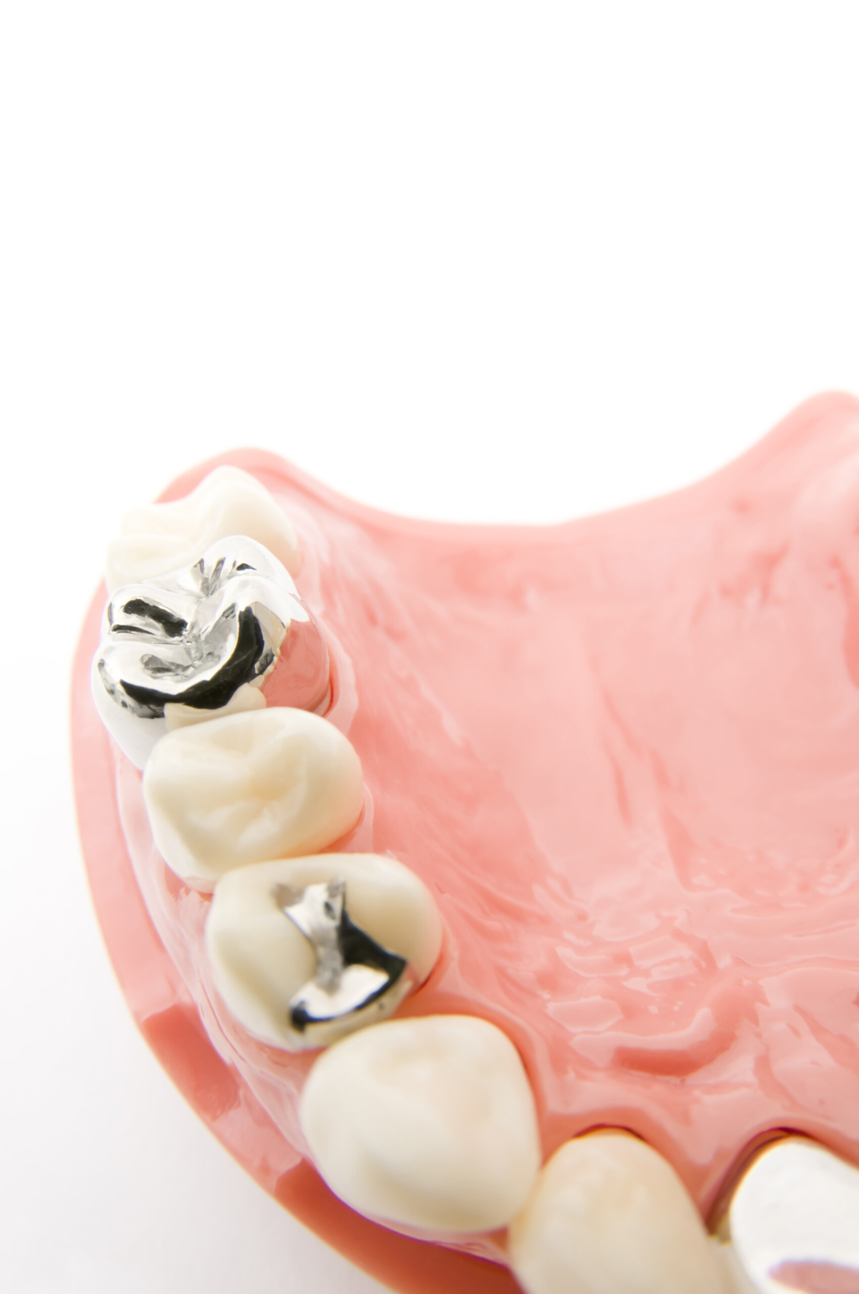 金属の歯科材料には様々なリスクがあります