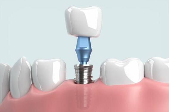 インプラントとは？失った歯を補う治療法の比較！
